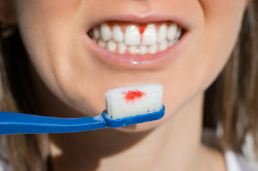 fogíny vérzés fogíny betegség